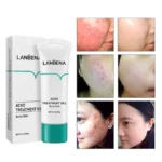 ⁦LANBENA ACNE TREATMENT GEL 20G⁩ - الصورة ⁦3⁩
